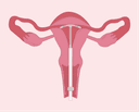 Guide to IUDs : Procedure, Symptoms, and Care